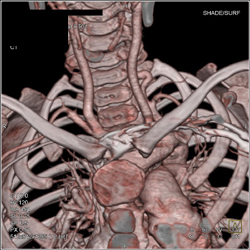 Loeys-Dietz Syndrome - CTisus CT Scan