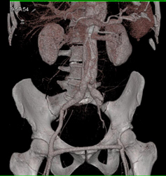 Aortic Dissection - CTisus CT Scan