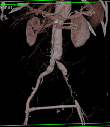 Aortic Dissection - CTisus CT Scan