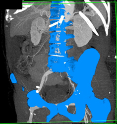 Aortic Dissection - CTisus CT Scan