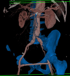 Aortic Dissection - CTisus CT Scan