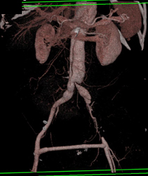 Aortic Dissection - CTisus CT Scan