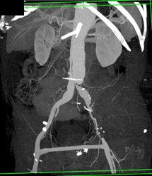 Aortic Dissection - CTisus CT Scan