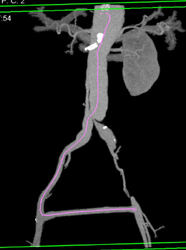 Aortic Dissection - CTisus CT Scan