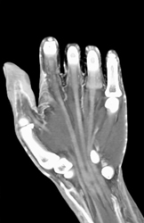 Aortic Dissection - CTisus CT Scan