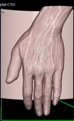 Aortic Dissection - CTisus CT Scan