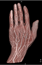 CTA of the Hand - CTisus CT Scan