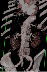 Splenic Artery Aneurysm - CTisus CT Scan