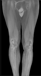 Peripheral Vascular Disease (PVD) With Popliteal Aneurysms - CTisus CT Scan