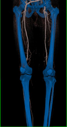 Diseased Superficial Femoral Arteries (SFAs) - CTisus CT Scan