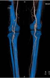 Diseased Superficial Femoral Arteries (SFAs) - CTisus CT Scan