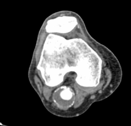 Popliteal Artery Aneurysm - CTisus CT Scan