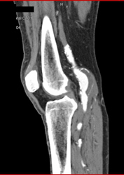 Popliteal Artery Aneurysm - CTisus CT Scan