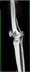 Popliteal Artery Aneurysm - CTisus CT Scan