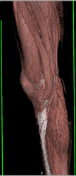 Popliteal Artery Aneurysm - CTisus CT Scan