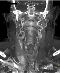 Carotid Ectasic in Loeys-Dietz Syndrome - CTisus CT Scan