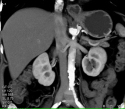 Celiac Dissection and Aneurysm - CTisus CT Scan