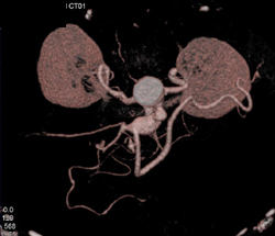 Celiac Artery Aneurysm - CTisus CT Scan