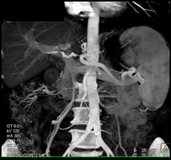 Hepatic Artery Stenosis S/P Liver Transplant - CTisus CT Scan