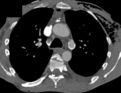 Ductus Aneurysm - CTisus CT Scan