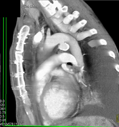 Ductus Aneurysm - CTisus CT Scan