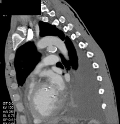 Ductus Aneurysm - CTisus CT Scan