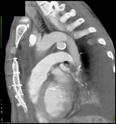 Ductus Aneurysm - CTisus CT Scan