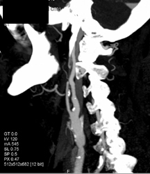 Post Angioplasty of Carotid Artery - CTisus CT Scan