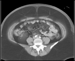 DIEP Protocol Study - CTisus CT Scan