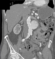 Renal Artery Aneurysm - CTisus CT Scan