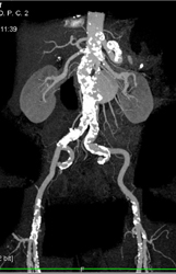 Renal Artery Aneurysm - CTisus CT Scan