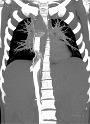 Inferior Vena Cava (IVC) Stent - CTisus CT Scan