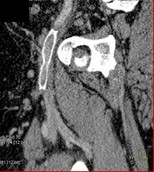 Femoral Vein Stent - CTisus CT Scan