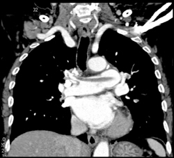 Pulmonary Embolism - CTisus CT Scan