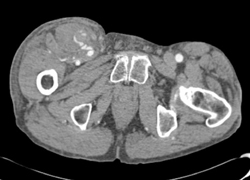 Bleed in Right Thigh With Active Extravasation and Hematoma - CTisus CT Scan