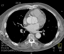 Type A Dissection - CTisus CT Scan