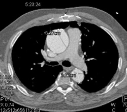 Type A Dissection - CTisus CT Scan