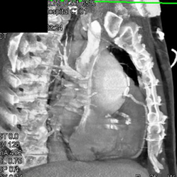 Bypass Graft Directly Behind Sternum in Patient Prior to Planned Dissection Repair - CTisus CT Scan