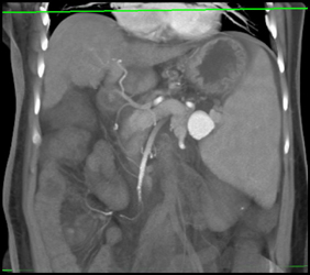 Splenic Artery Aneurysm - CTisus CT Scan