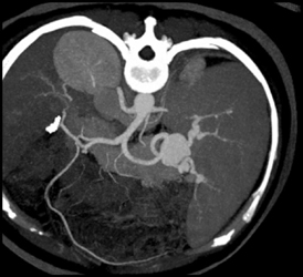 Splenic Artery Aneurysm - CTisus CT Scan