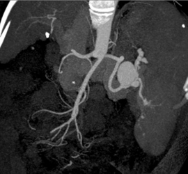 Splenic Artery Aneurysm - CTisus CT Scan