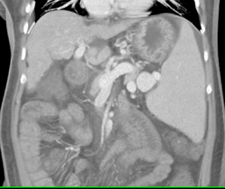 Splenic Artery Aneurysm - CTisus CT Scan