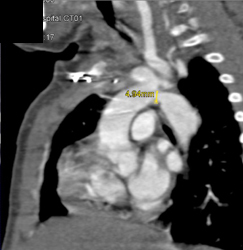 Coarctation of the Aorta - CTisus CT Scan