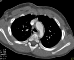 Coarctation of the Aorta - CTisus CT Scan