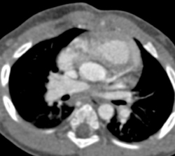 Coarctation of the Aorta - CTisus CT Scan