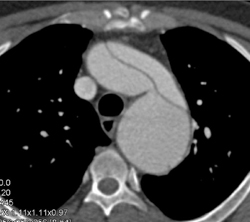 Type A Dissection - CTisus CT Scan