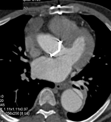 Type A Dissection - CTisus CT Scan