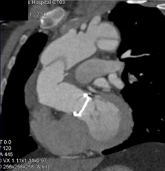 Type A Dissection - CTisus CT Scan