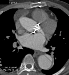 Normal Aortic Valve - CTisus CT Scan