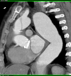 Normal Aortic Valve - CTisus CT Scan